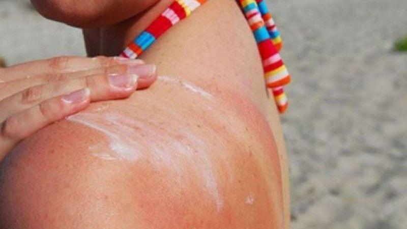Dị ứng kem chống nắng: Nguyên nhân và cách xử lý hiệu quả