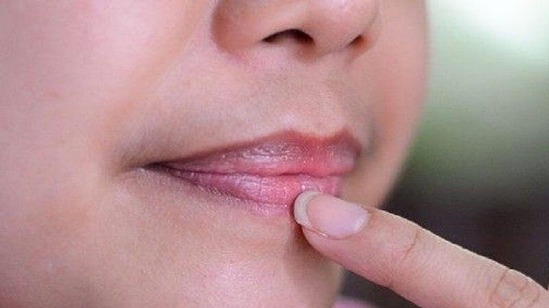 Giảm thâm khoé miệng hiệu quả với 6 nguyên liệu dễ tìm trong gia đình