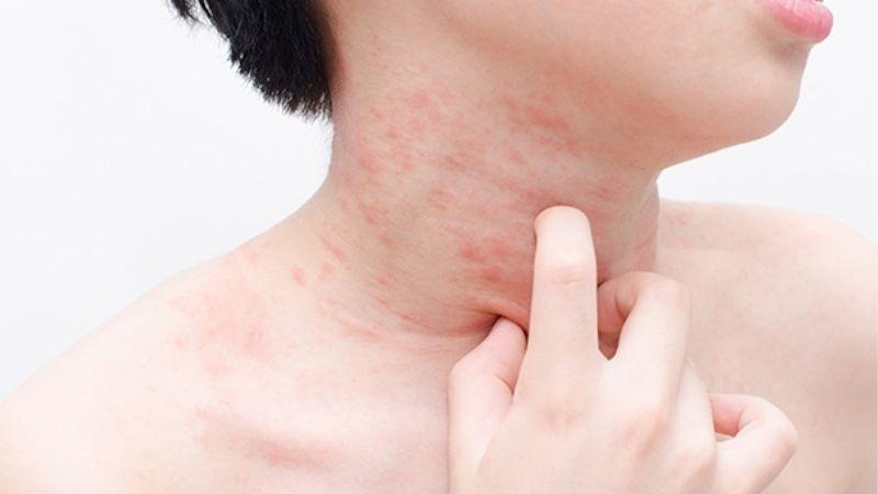 Nắng nóng có thể mang lại những tác động tiêu cực cho cơ thể, ảnh hưởng sâu sắc đến sức khỏe của chúng ta. Việc hiểu rõ và chủ động bảo vệ sức khỏe trong những ngày hè oi ả là vô cùng quan trọng.