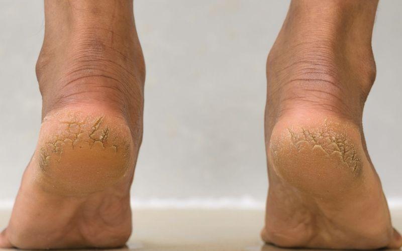 Khám phá 3 cách trị nứt gót chân hiệu quả bằng Vaseline ngay tại nhà