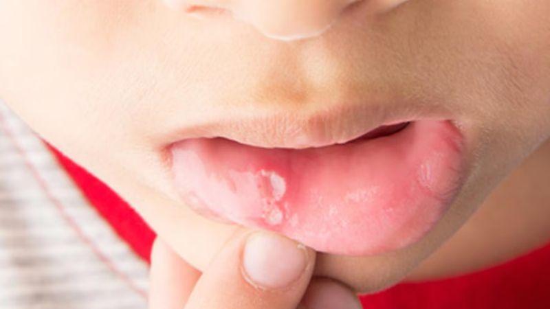 Khi trẻ bị nhiệt miệng, việc lựa chọn thực phẩm phù hợp là điều cần thiết để giúp con nhanh chóng hồi phục. Bài viết này sẽ chia sẻ những thực phẩm nên ăn và nên tránh khi trẻ bị nhiệt miệng để con nhanh khỏe lại.
