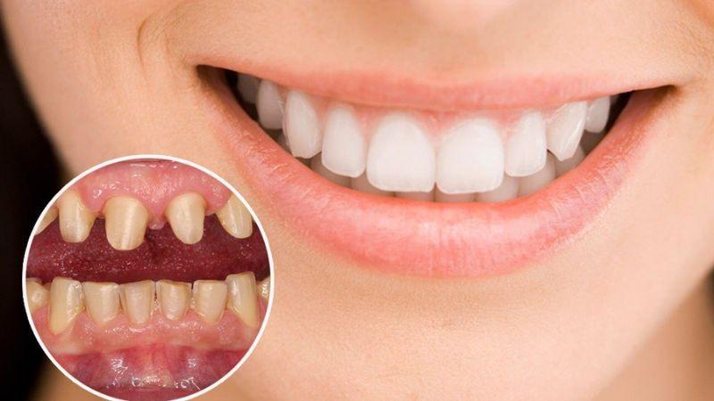 Có thể bọc sứ cho 4 răng cửa hay không? Chi phí thực hiện là bao nhiêu?