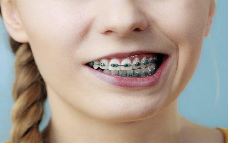 Liệu việc niềng răng có gây hiện tượng hóp má, hóp thái dương không?