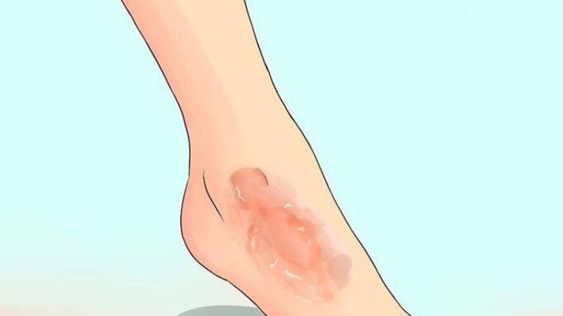 Khi gặp phải bỏng do bô xe máy, việc sơ cứu và điều trị đúng cách là yếu tố quan trọng giúp tránh biến chứng như nhiễm trùng hay để lại sẹo. Cùng khám phá cách trị bỏng bô xe máy hiệu quả mà không lo sẹo nhé.
