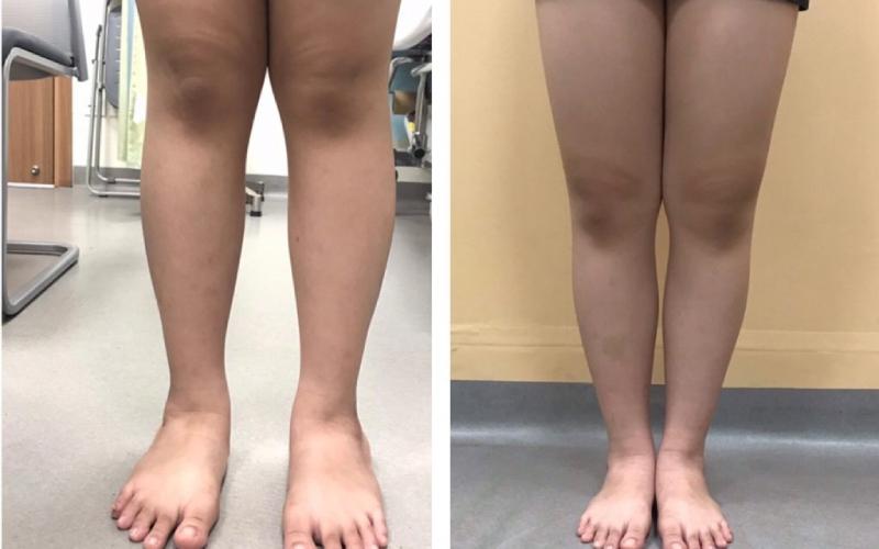 Chân chữ X ở trẻ em là hiện tượng gì và liệu nó có thể được chữa trị hay không?