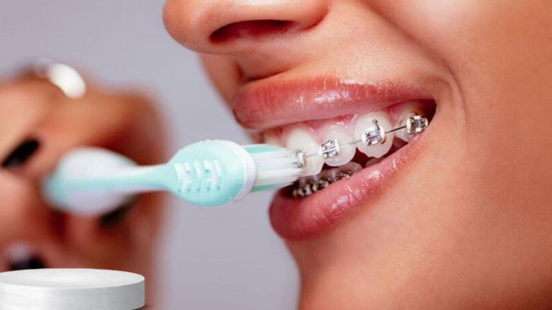 9 loại kem đánh răng phù hợp nhất cho người niềng răng