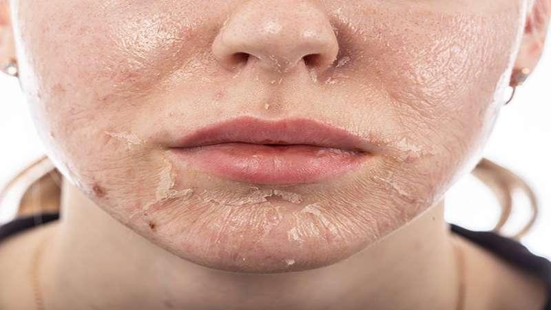 Khám phá phương pháp peel da với Glycolic Acid và những điều bạn cần nắm rõ.