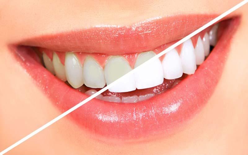 Việc tẩy trắng răng có gây ảnh hưởng đến men răng không? Các phương pháp tẩy trắng răng hiệu quả bạn nên biết