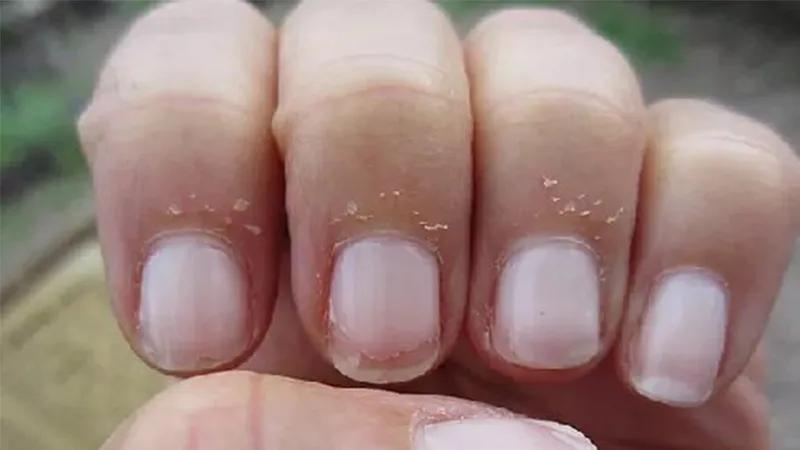 Làm sao để chữa trị tình trạng xước măng rô (xước da đầu ngón tay) bằng những phương pháp đơn giản và hiệu quả?