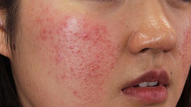 Sử dụng kem đánh răng không đúng cách để trị mụn có thể dẫn đến những hậu quả không thể lường trước.