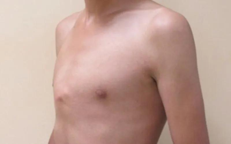 Dị tật xương ức gà là gì? Liệu tình trạng này có nguy hiểm đối với trẻ em không?