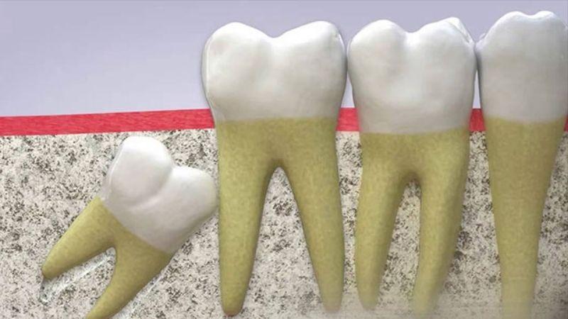 Hướng dẫn sử dụng bàn chải đánh răng sau khi nhổ răng khôn