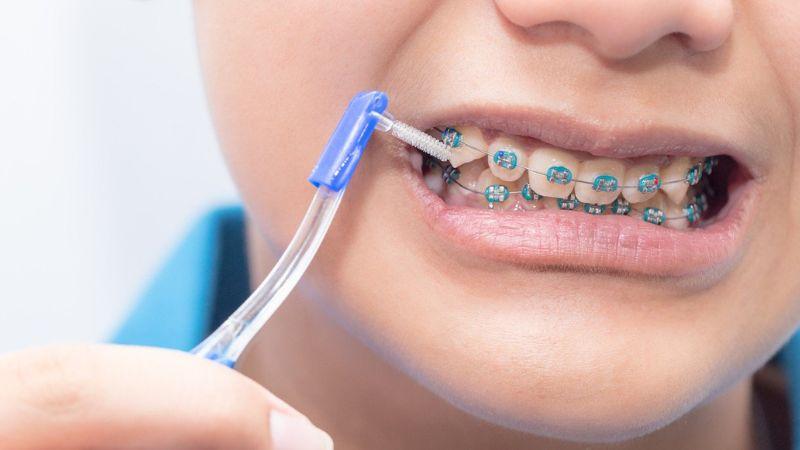 Bàn chải kẽ răng là một dụng cụ đặc biệt, có thiết kế nhỏ gọn giúp làm sạch sâu các khe răng, rất hữu ích trong việc duy trì vệ sinh răng miệng, đặc biệt là cho người niềng răng.
