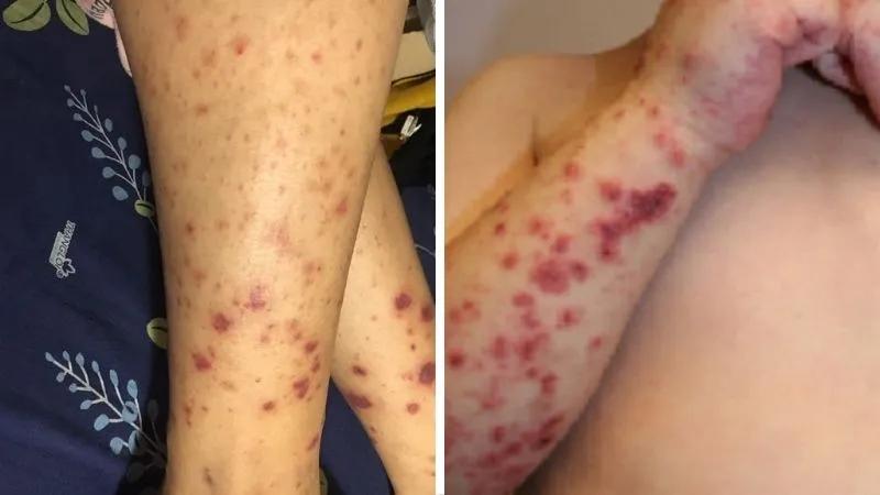 Viêm mạch IgA là gì và liệu bệnh này có gây nguy hiểm cho trẻ em không?