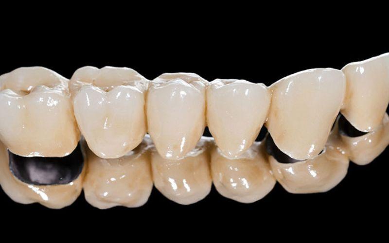 Hiện nay có bao nhiêu loại răng sứ và đâu là những loại răng sứ phổ biến nhất? Hãy cùng khám phá trong bài viết này.