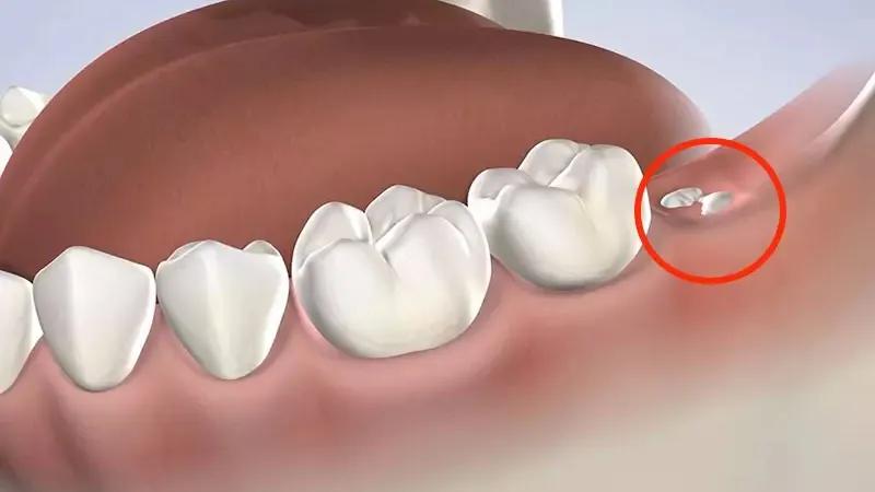 Đau răng khôn, phải làm sao? 11 cách giảm đau hiệu quả