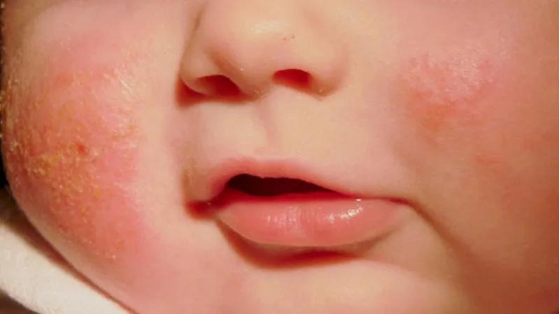 Nấm da ở trẻ sơ sinh là bệnh gì và làm sao để điều trị hiệu quả? Hãy cùng khám phá những thông tin cần thiết để giúp bé khỏi bệnh nhanh chóng.
