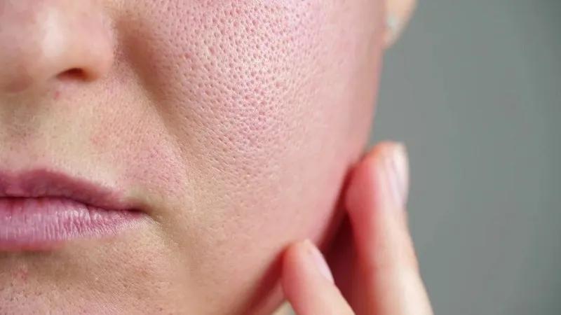 Sebum là gì? Tìm hiểu về No Sebum và Phức hợp Anti Sebum P' trong các sản phẩm làm đẹp