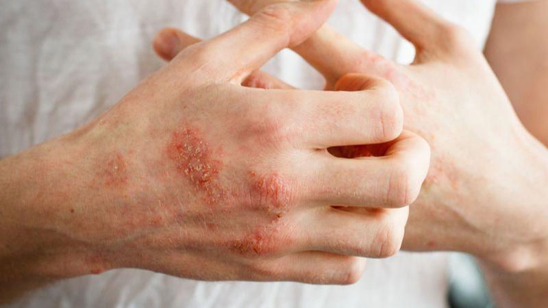 3 cách giúp giảm tình trạng dị ứng da tay khi giặt giũ và rửa chén