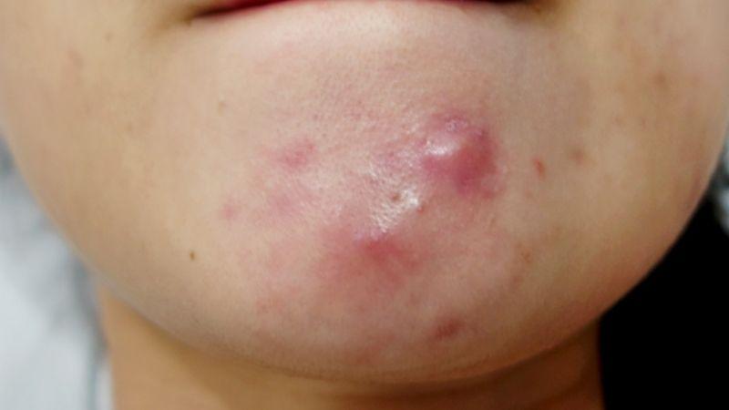 Phương pháp hiệu quả trong việc điều trị mụn nang và mụn bọc