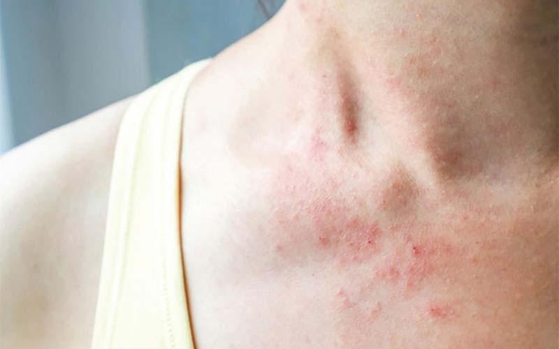Bệnh chàm là gì? Những điều cần tránh và thực phẩm nên ăn để mau chóng hồi phục?