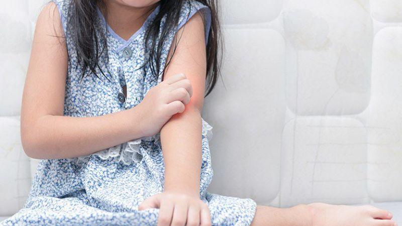 Liệu vết cắn của bọ chét có thể gây hại không? Bạn cần làm gì khi bị bọ chét cắn?