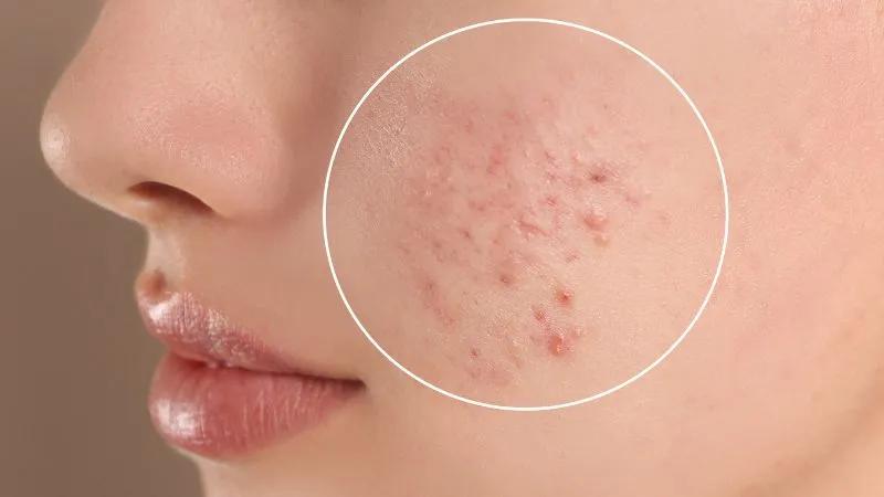 Việc bà bầu bị mụn khi mang thai có phải là dấu hiệu của con trai hay con gái? Liệu thông tin này có chính xác?