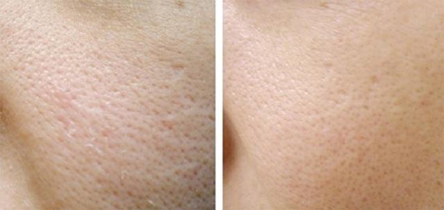 7 thói quen hằng ngày khiến lỗ chân lông của bạn luôn bị tắc nghẽn