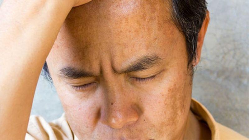 4 loại kem trị nám cho nam giới hiệu quả và được ưa chuộng nhất hiện nay