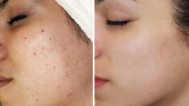 Phương pháp trị mụn ẩn hiệu quả với AHA/BHA cho làn da sạch khỏe.