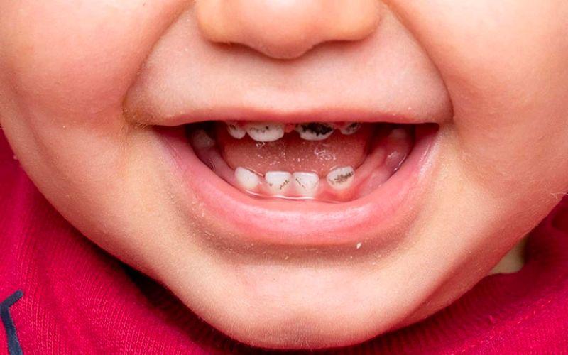 Vì sao răng của trẻ lại bị đen? Cách nào để khắc phục tình trạng này hiệu quả?