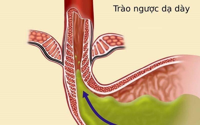 Trào ngược dạ dày thực quản là căn bệnh gì và làm sao để có chế độ ăn uống hợp lý khi mắc phải?