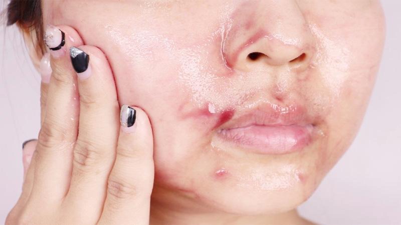 Khám phá Acid Peel - phương pháp tái tạo làn da trẻ trung