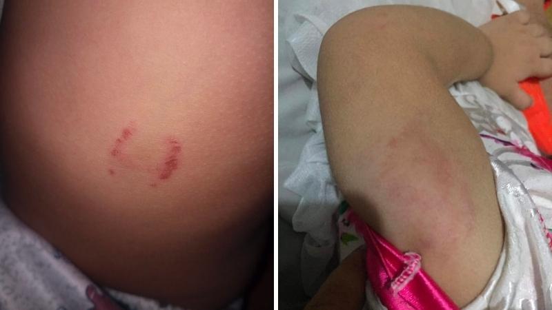 Đừng xem nhẹ những vết răng cắn xuất hiện trên cơ thể trẻ nhỏ