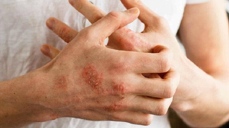 Chế độ ăn uống cho người viêm da cơ địa: Nên ăn gì và cần tránh thực phẩm nào?