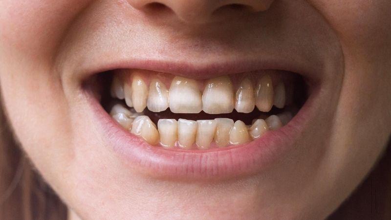 Vì sao ăn đồ chua lại khiến răng bị ê buốt?