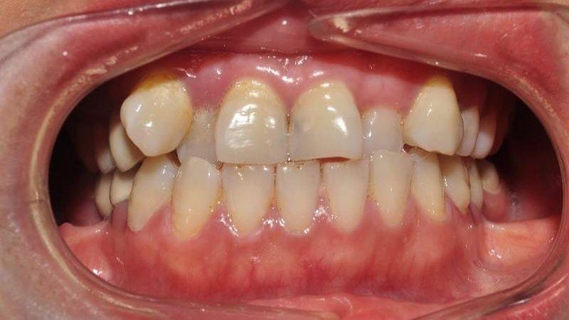 Răng lòi xỉ là tình trạng răng miệng phổ biến mà nhiều người gặp phải. Vậy răng lòi xỉ là gì và làm thế nào để cải thiện tình trạng này một cách hiệu quả?