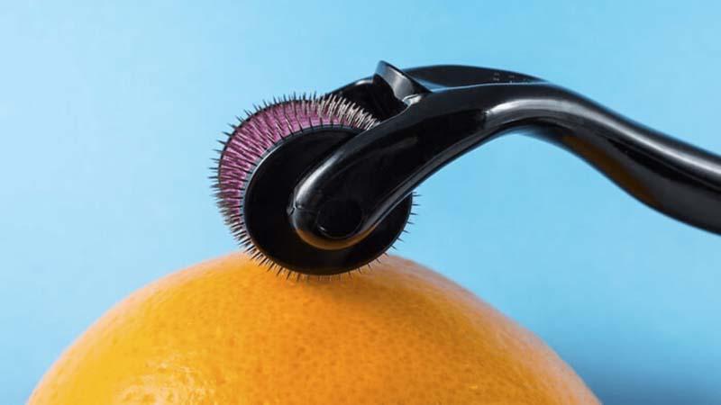 Lăn kim kết hợp minoxidil 5% có thật sự mang lại hiệu quả trong việc trị hói đầu?