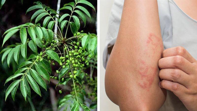 Dị ứng cây sơn độc: Nguyên nhân và cách phòng tránh hiệu quả