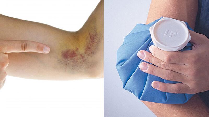 11 phương pháp giúp vết bầm tím mờ đi nhanh chóng, đơn giản và hiệu quả ngay tại nhà