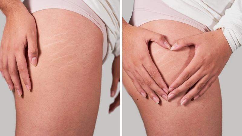 Ngứa ngáy do vết rạn sau sinh: Nguyên nhân từ đâu và làm sao để khắc phục?