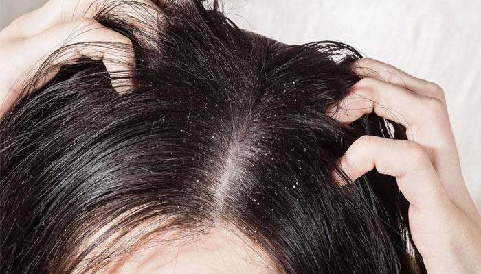 Vì sao da đầu lại bị ngứa?