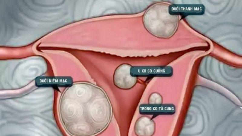 Chế độ dinh dưỡng cho người bị nhân xơ tử cung - Nên ăn gì và cần tránh những gì?