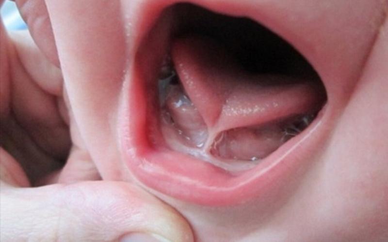 Khi nào trẻ cần can thiệp phẫu thuật cắt ngắn hãm lưỡi?