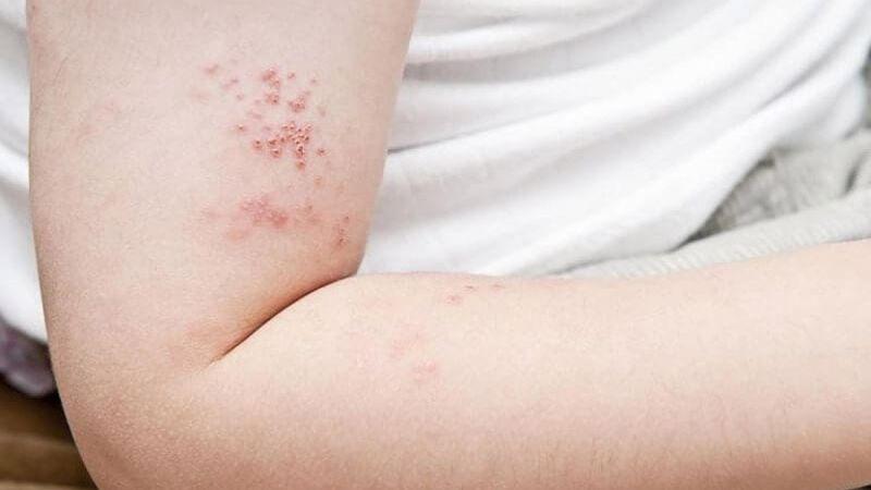 Bệnh zona ở trẻ em có thực sự nguy hiểm? Những dấu hiệu nhận biết bệnh zona
