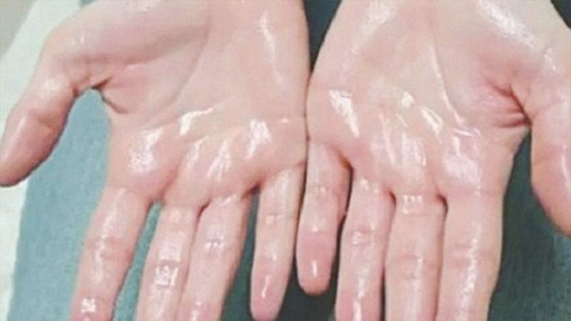 10 phương pháp hiệu quả giúp giảm mồ hôi tay ngay tại nhà