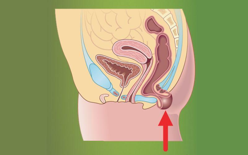 Tìm hiểu nguyên nhân và những dấu hiệu sa tử cung sau sinh mà các mẹ cần lưu ý để bảo vệ sức khỏe của mình.