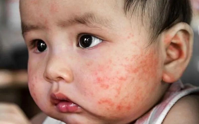 Làm thế nào để bảo vệ làn da của trẻ bị chàm sữa trong mùa đông lạnh giá?