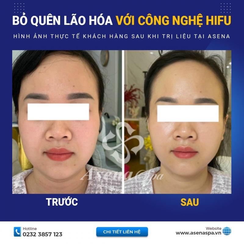 Top 10 Địa chỉ xóa nếp nhăn uy tín tại Quảng Bình