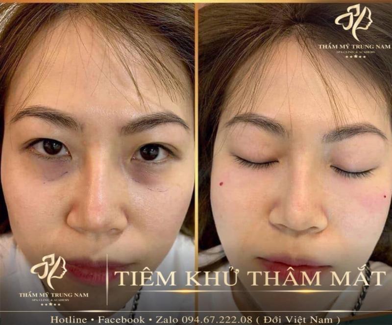 Top 6 địa chỉ trị thâm uy tín tại Hà Tĩnh